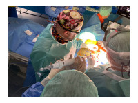 nová metoda náhrady mitrální chlopně - foto z operace