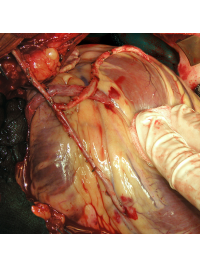 Výsledný stav revaskularizace myokardu dvěma mamárními tepnami a jedním žilním štěpem (bez mimotělního oběhu). 