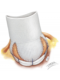 Remodelace aortálního kořene spojená s anuloplastikou pomocí prstence