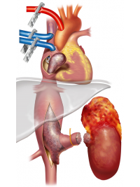 Nádor levé ledviny s prorůstáním žilním řečištěm až do pravého srdce