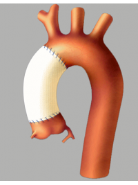 Náhrada vzestupné aorty cévní protézou