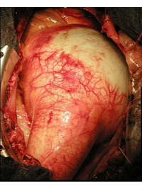 Výduť (aneuryzma) vzestupné aorty