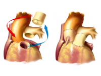 Schéma Rossovy operace: Odpojení kořene plicnice (vlevo) a jeho následná implantace do aortálního ústí (vpravo). Výkon je doplněn implantací plicnicového alograftu do plicnicového ústí.