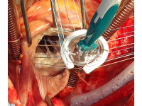 Implantace anuloplastického prstence do trikuspidálního ústí