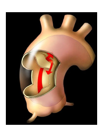 Schema aortální disekce