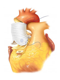 Záchovná operace aortální chlopně. Remodelace dle Yacouba.