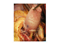 Remodelace aortálního kořene podle Yacouba