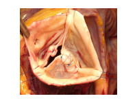 Uzávěr rozštěpu cípu u bikuspidální aortální chlopně