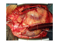 Operace ICHS v mimotělním oběhu. Dva žilní aortokoronární bypassy a mamarokoronární bypass.